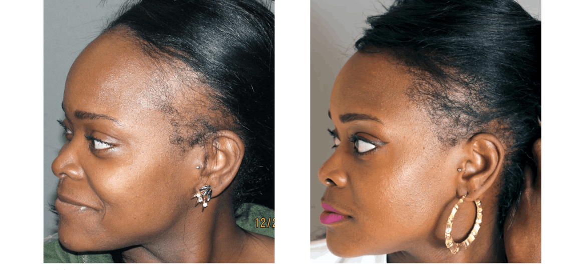 Traction alopecia causing hairline thinning along the temples due to repeated tension from tight hairstyles