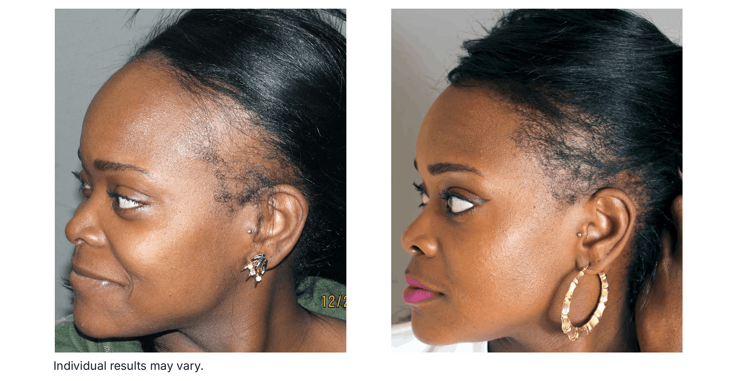Traction alopecia causing hairline thinning along the temples due to repeated tension from tight hairstyles