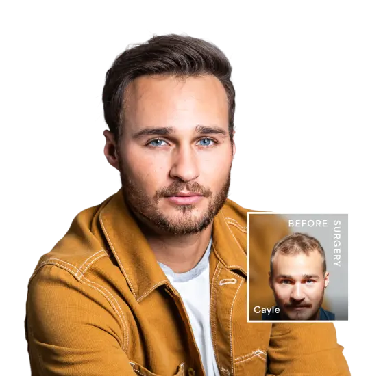 Hair Replacement for Thinning Hair