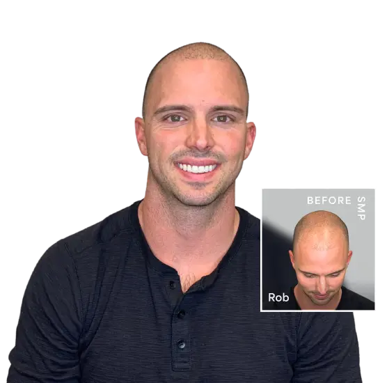 Hair Transplant