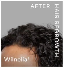 Wilnelia-after-hair-regrowth