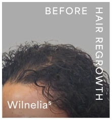 Wilnelia-before-hair-regrowth