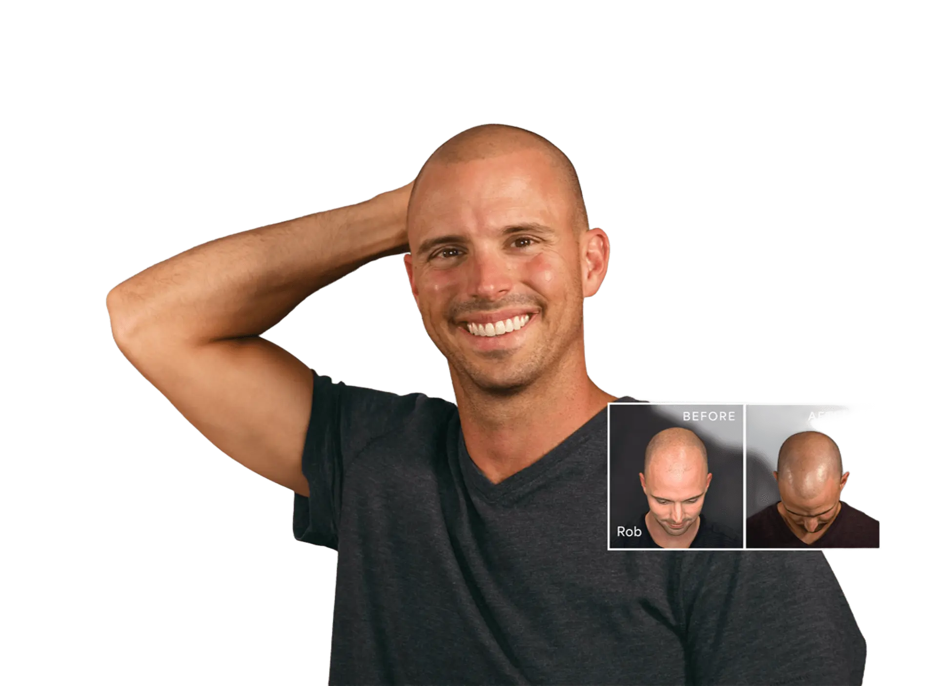 HairClub SMP scalp micropigmentation