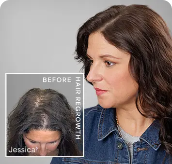 Jesica-before-hair-regrowth-mobile