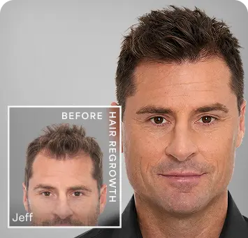 jeff-before-hair-regrowth-mobile