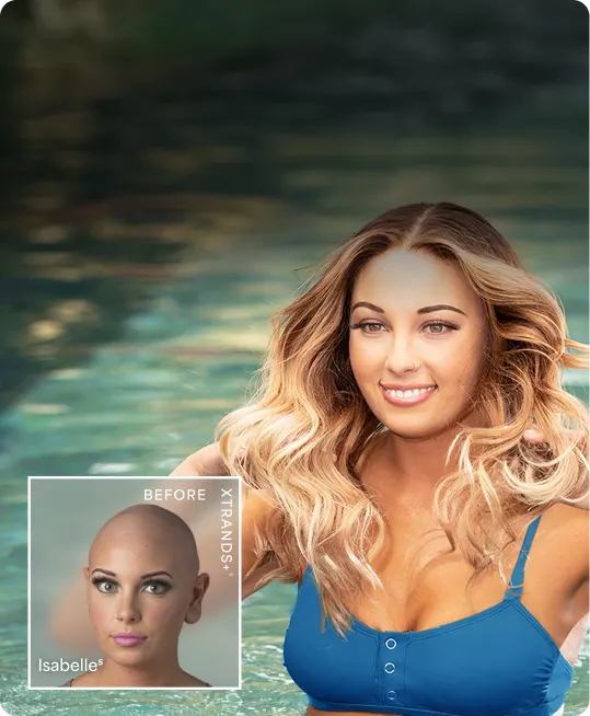 Alopecia