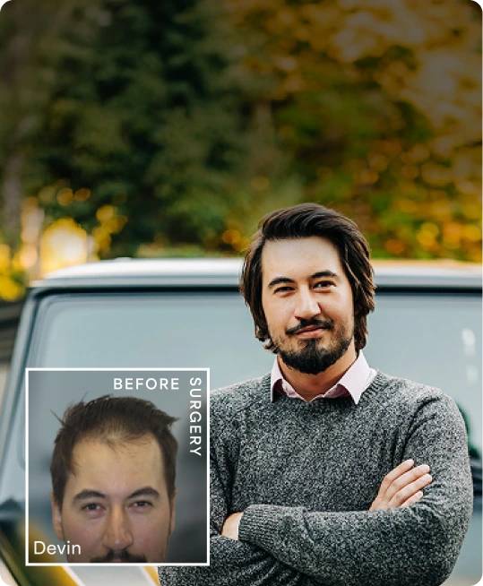 Hair Transplant