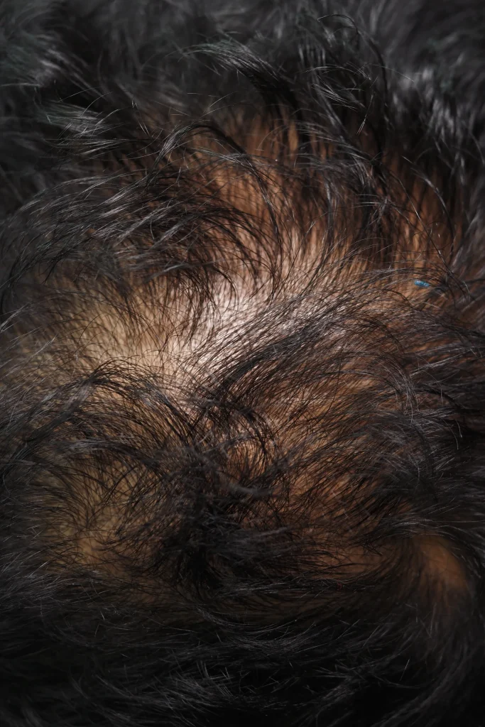 Norwood Scale Hair Loss