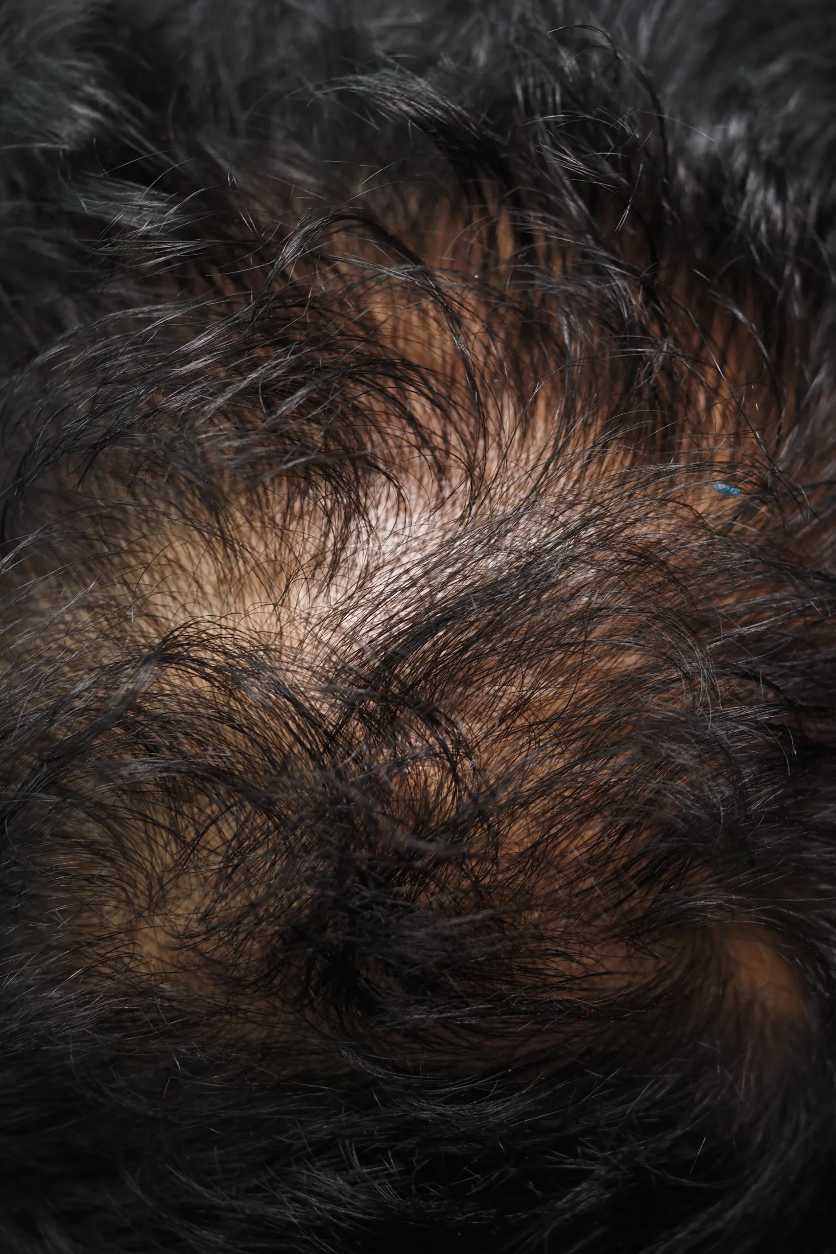Norwood Scale Hair Loss