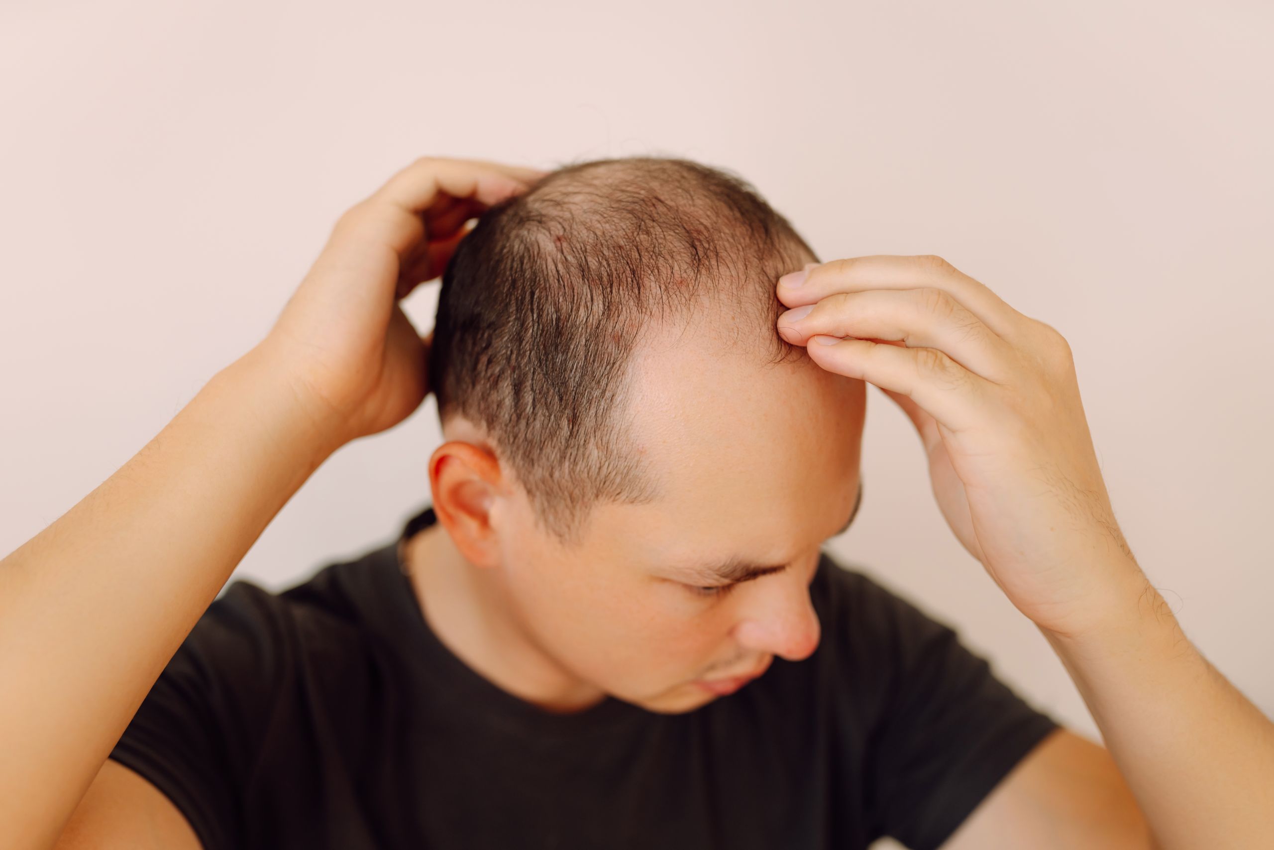 Baldness on the head of a middle-aged man. Hair loss. Male hair loss, early baldness and alopecia.