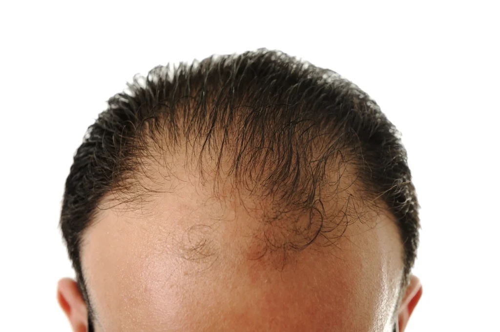 man with thinning