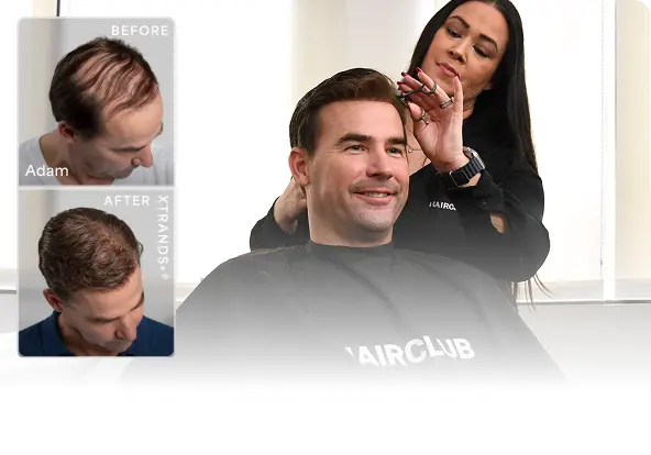 Before-After-Hair-Restoration