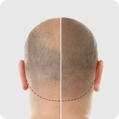 Individuals with Alopecia