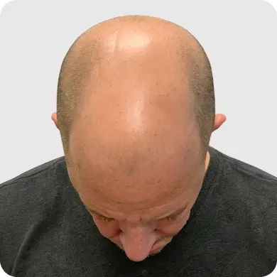 Men with Pattern Baldness
