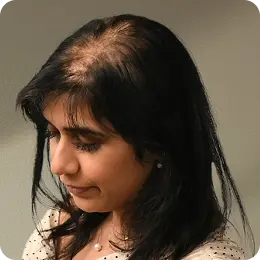 Women Experiencing  Volume Loss