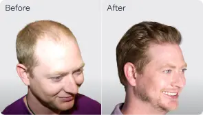 Blair T-before-after