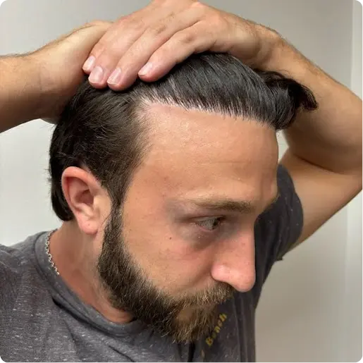 Unnatural-Looking Hairlines